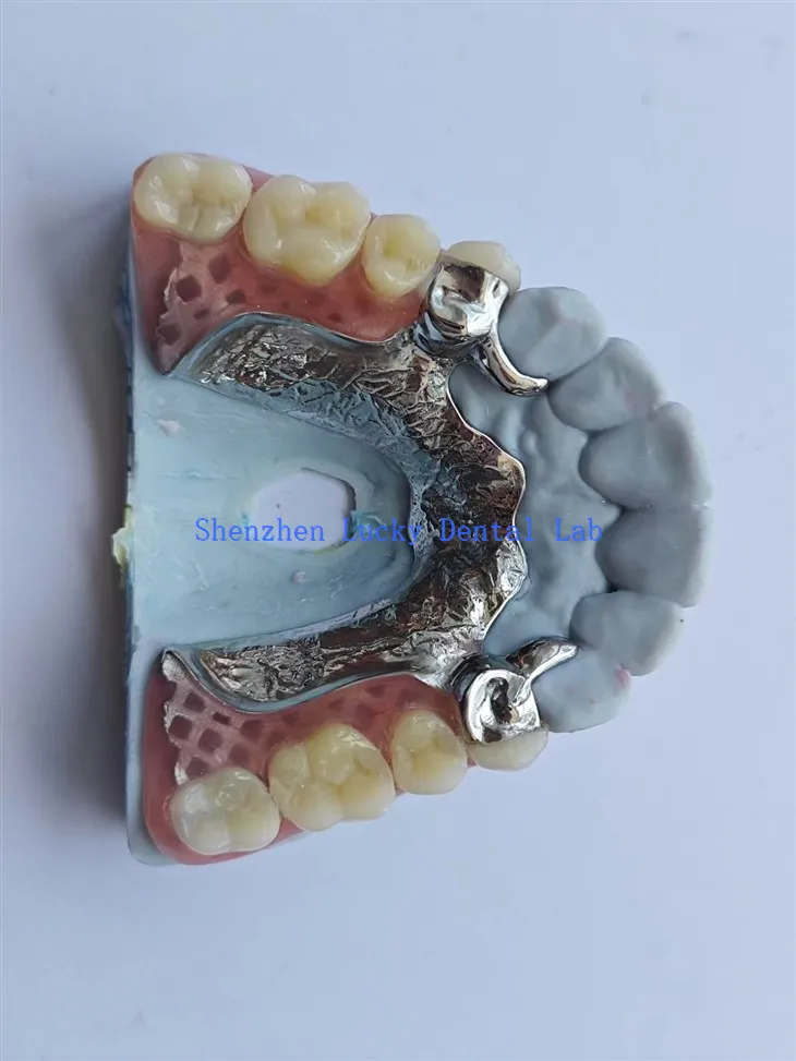 3D Print Alloy Tooth Back Dental Metal Framework Dengan Gigitiruan Akrilik