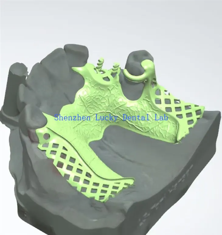 Produsen kerangka kerja logam gigi cetak 3D