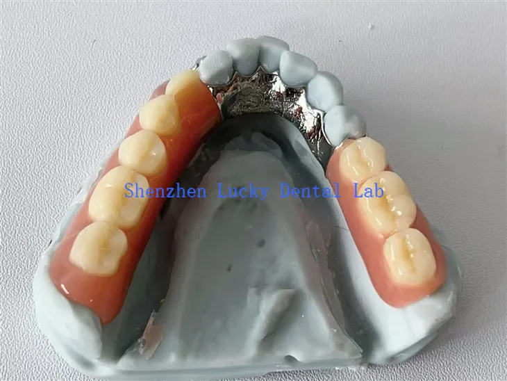 3D Print Lingual Plate Dental Metal Framework dengan Gigitiruan Akrilik