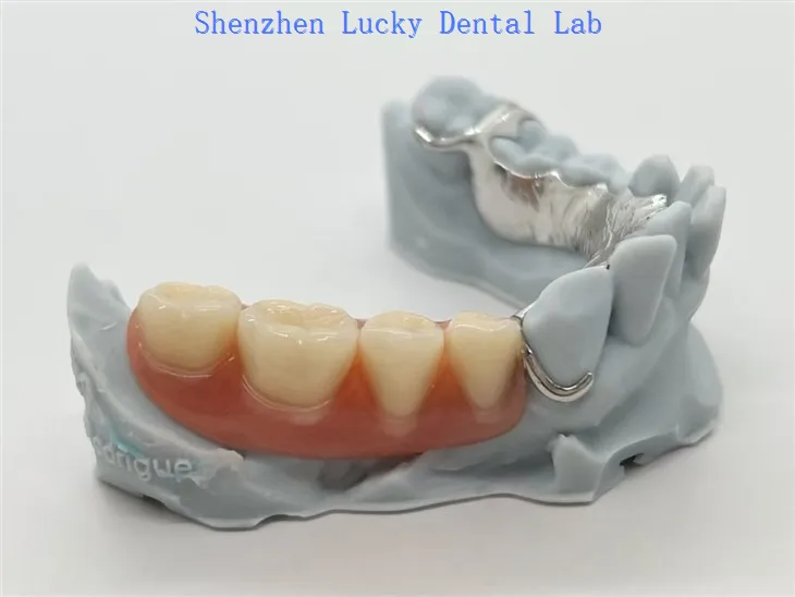 Kerangka Co Cr Logam Cetak 3D Dengan Gigi Palsu Akrilik