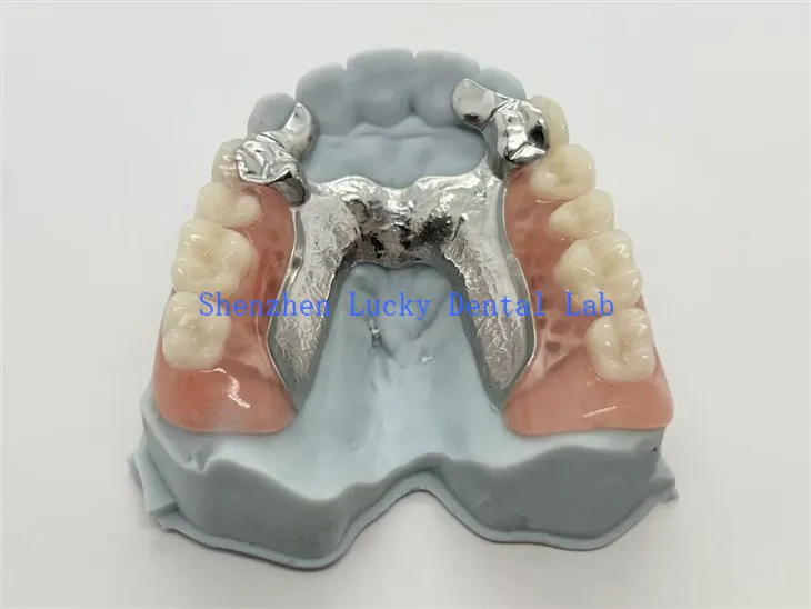 Gigi Tiruan Sebagian Logam Cetak 3D Dengan Penopang Gigi Paduan