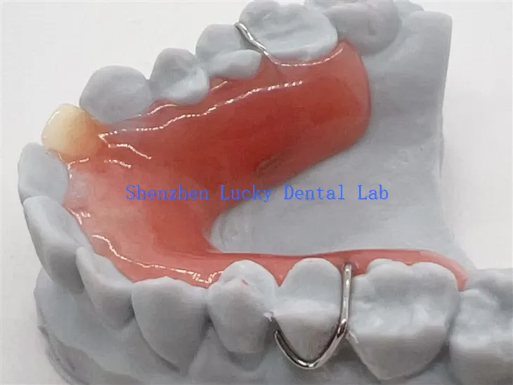 Gigi Tiruan Sebagian Dapat Dilepas Cetak 3D Dengan Basis Akrilik