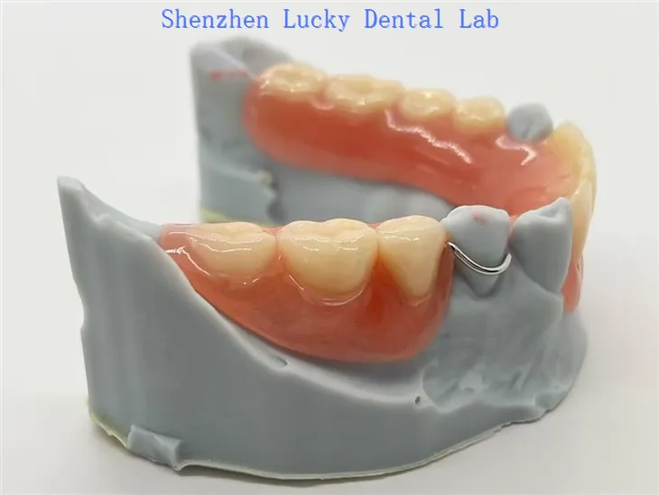 Gigitiruan parsial akrilik yang dapat dilepas dengan jepitan kawat