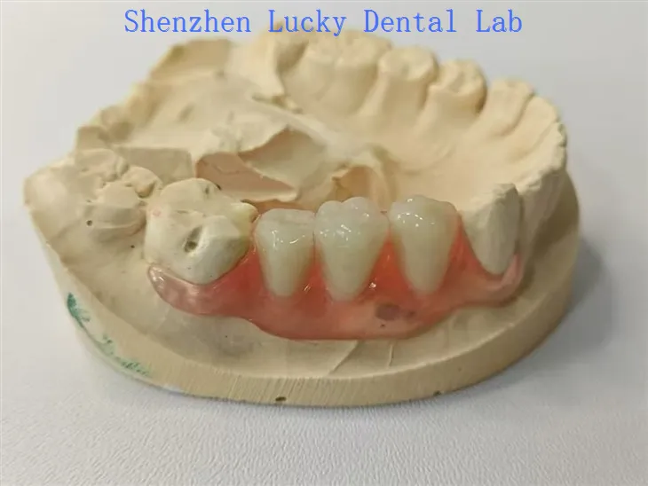 Sirip Valplast Gigi Estetika