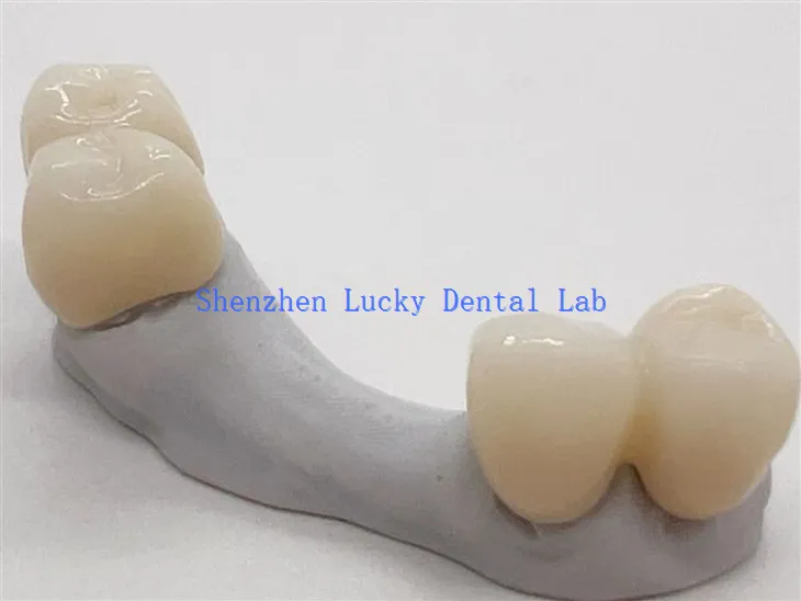 Jembatan Zirkonia Gigi Estetika