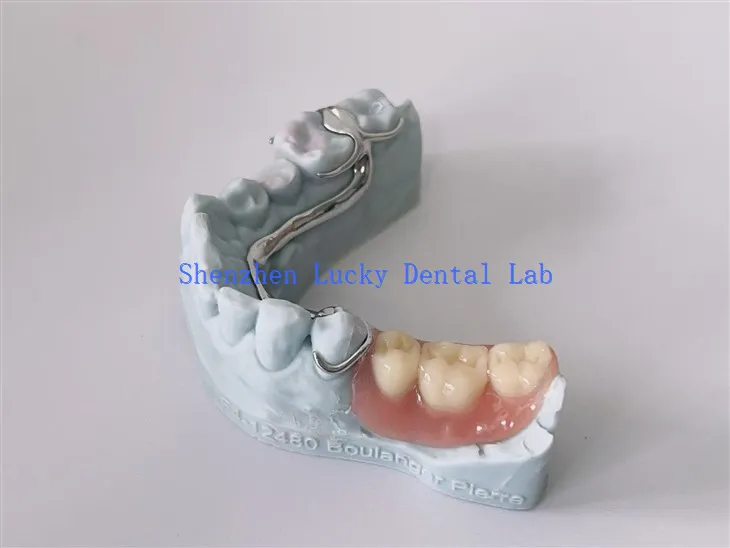 Kerangka kerja logam COCR COCR Dental 3D yang terjangkau dengan gigitiruan akrilik