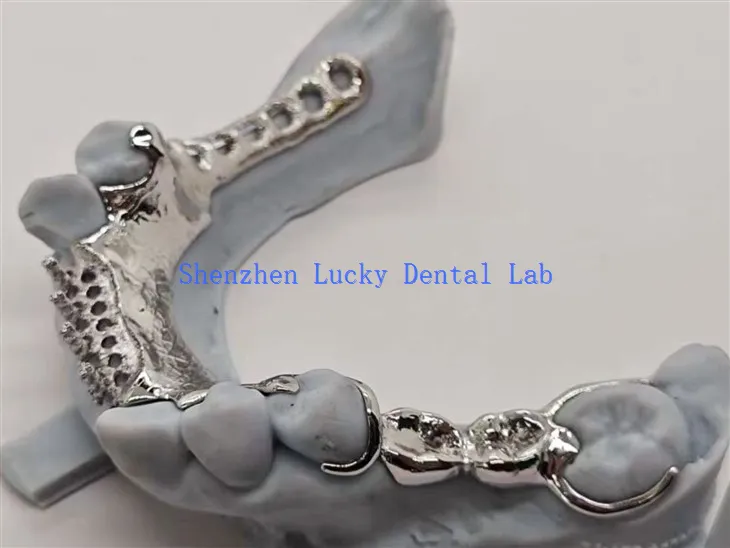 Desain Gigi Berbahan Paduan Dengan Kerangka Logam