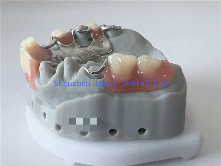 China 3D Print Dental Metal Framework dengan Aker Clasp Factory