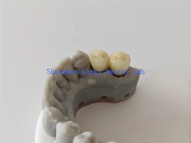 China 3D Print Pfm Cocr Dental Crown Factory