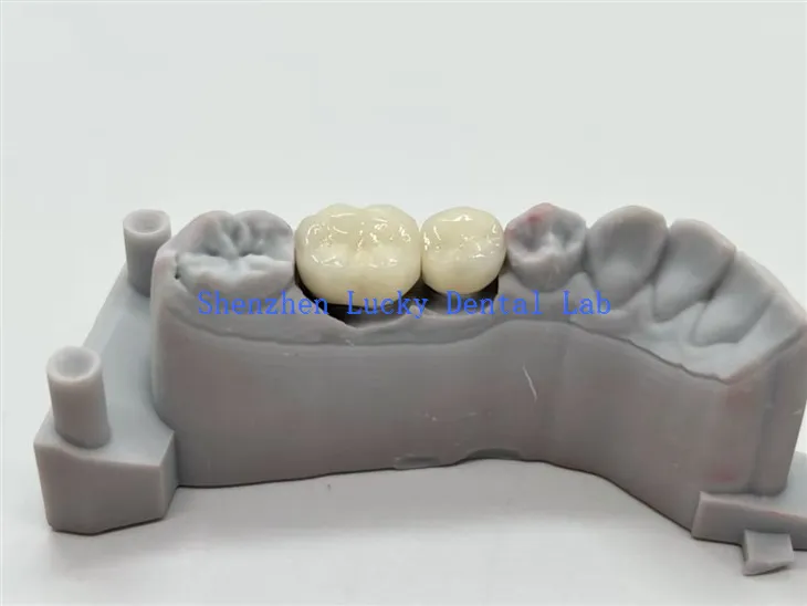 Mahkota Gigi PFM Paduan CoCr