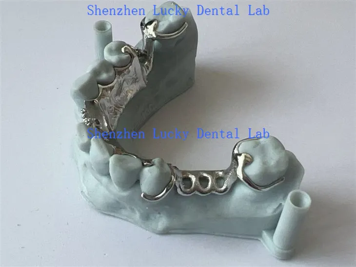Kerangka kerja logam cetak 3D dengan laboratorium pelat lingual