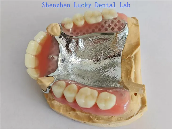Gigitiruan akrilik parsial khusus dengan logam laboratorium pelat palatal logam