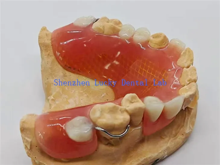 Gigitiruan parsial yang dapat dilepas dengan mesh logam