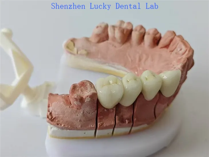 PFM Gigi COCR Jembatan Tidak Ada Lab Gigi Logam