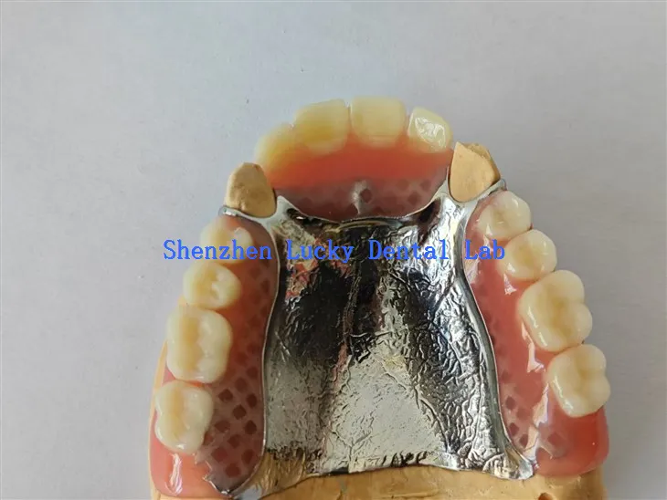 Gigitiruan akrilik parsial yang bagus dengan laboratorium gigi pelat palatal logam