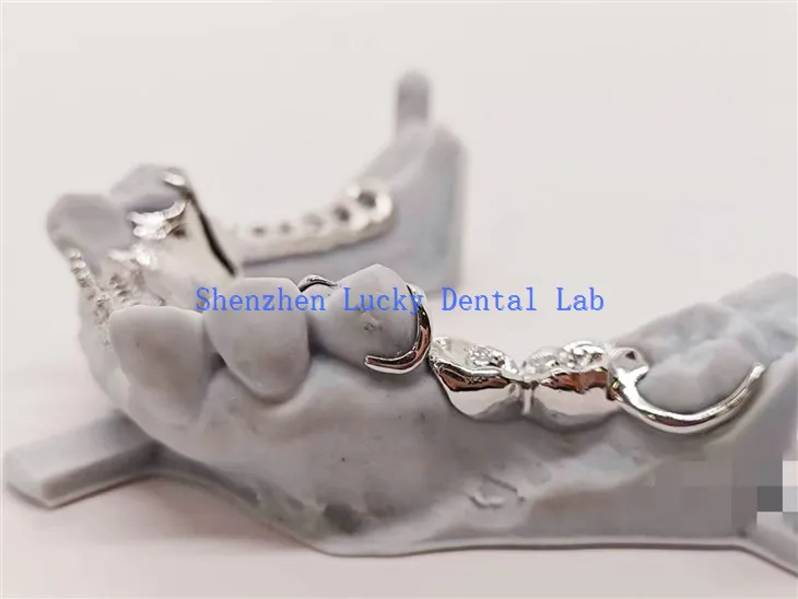 Kerangka logam dengan desain gigi yang didukung paduan