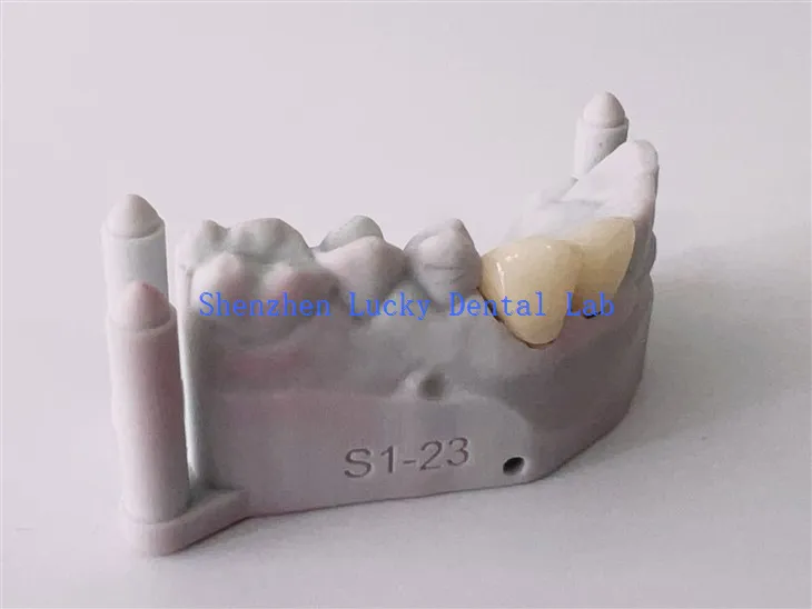 Produsen COCR Bridge PFM COCR Dental 3D Cetak Alami
