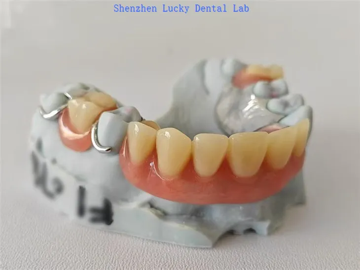 Gigi Tiruan Akrilik Parsial Dengan Rangka Logam Gesper Kawat