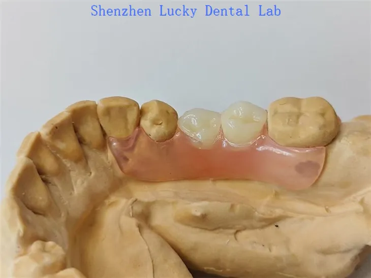 Gigitiruan gigi fleksibel parsial dengan produsen jepit valplast