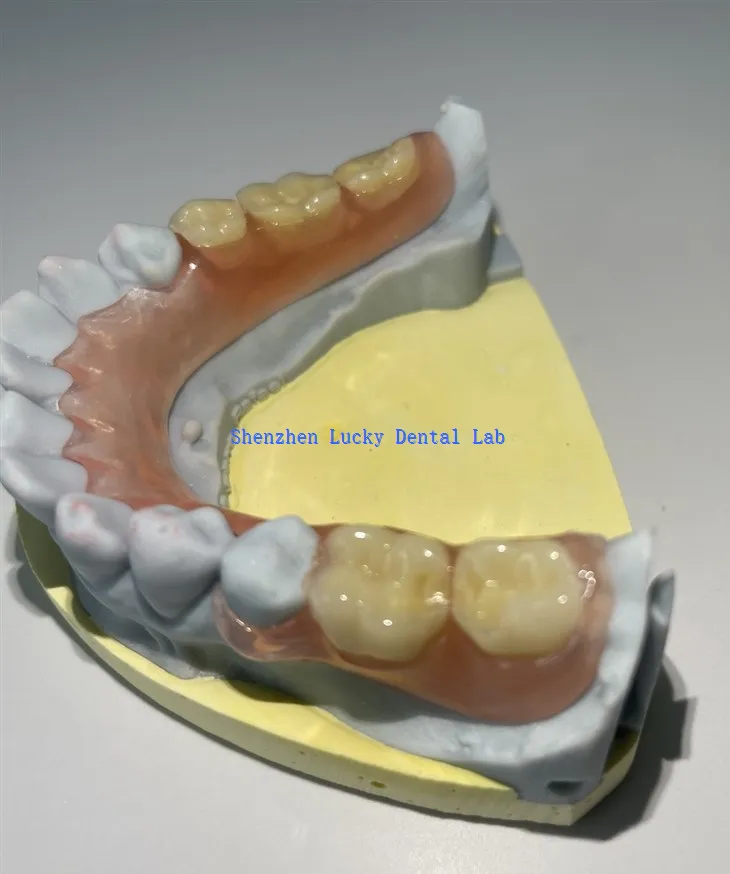 Gigitiruan fleksibel parsial