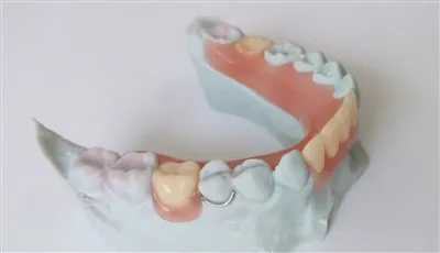 3D Cetak Gigitiruan Akrilik Parsial Gigi Dengan Gesper Kawat