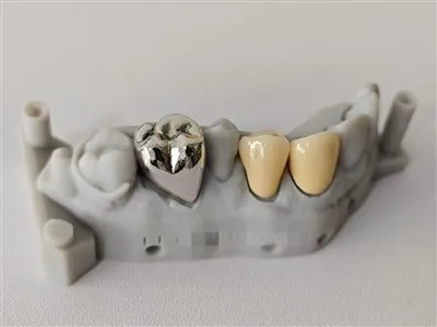 3D Print Dental PFM COCR Mahkota dengan mahkota logam penuh