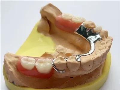 Kerangka logam gigi bar lingual dengan gigitiruan akrilik parsial