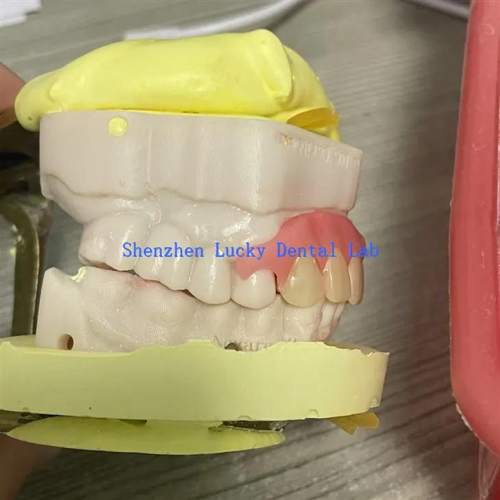 Cobalah gigitiruan fleksibel parsial yang nyaman di lab gigi