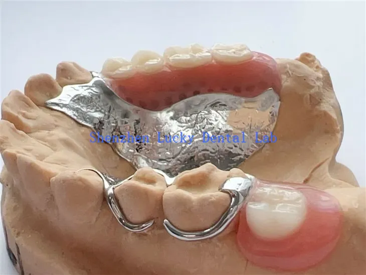 Kerangka kerja logam gigi genggam dengan gigitiruan akrilik parsial